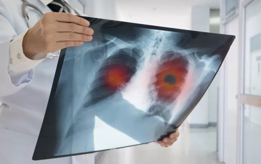 Vacina para prevenir câncer de pulmão inicia estudos em humanos; entenda como funciona e quem deve receber