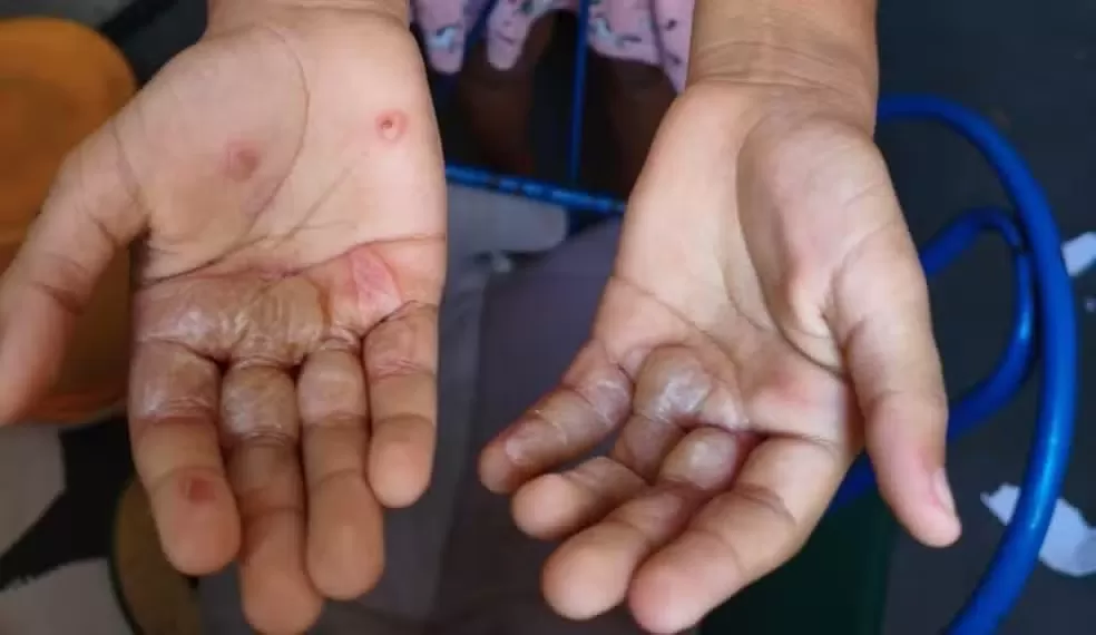 Mulher é presa suspeita de queimar a mão da filha com ovos quentes, em João Pessoa